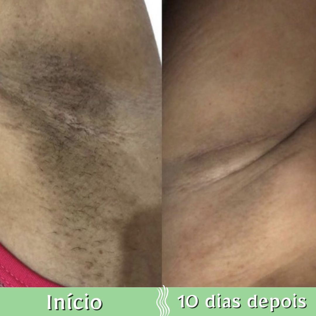 Creme Clareador de Pele Áreas Escurecidas - PerfectFace