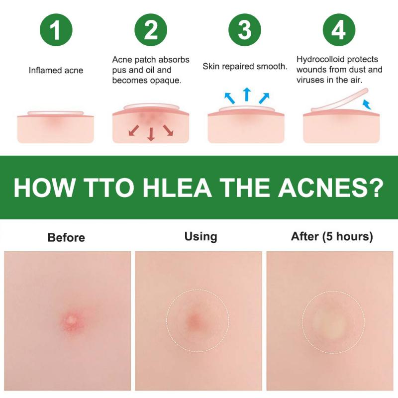 Adesivo para Acne Secativo e Clareador - 24 Peças