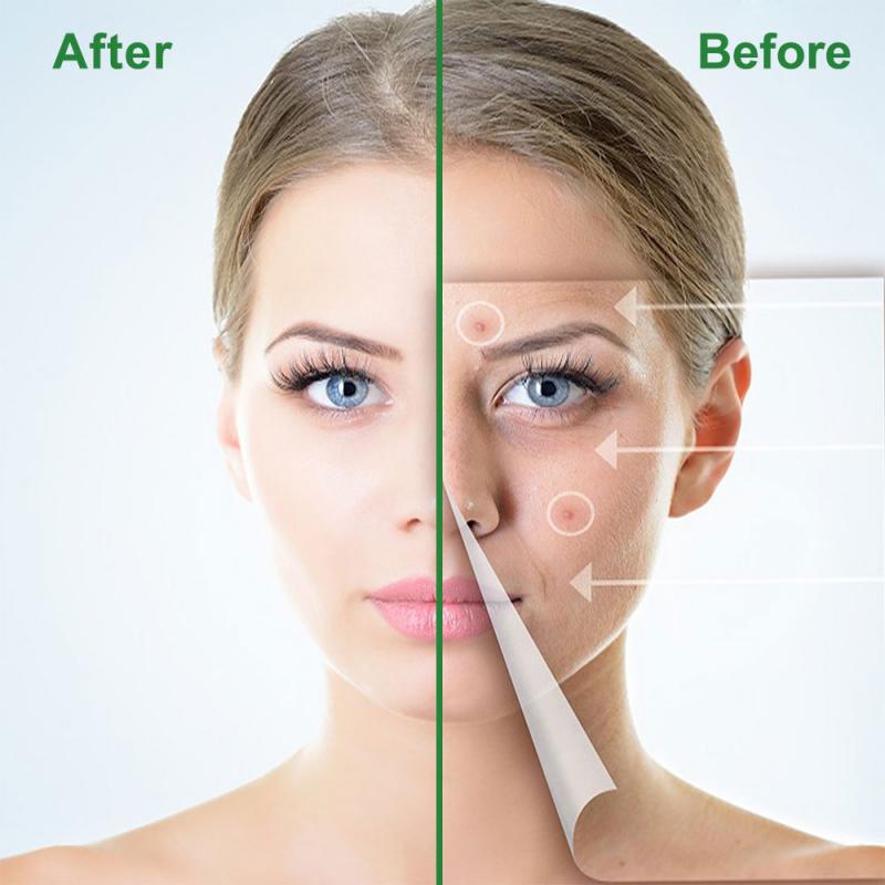 Adesivo para Acne Secativo e Clareador - 24 Peças