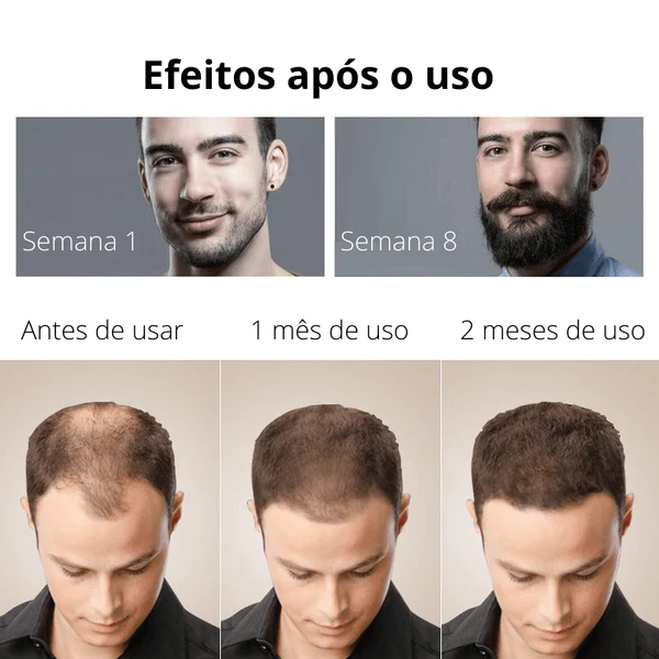 Kit De Crescimento Capilar - Mixidil™